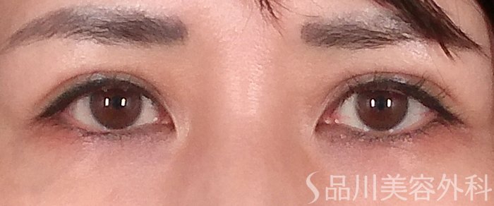 症例NO.70342のAFTER写真