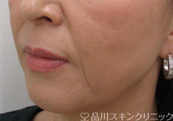 症例NO.39792のBEFORE写真