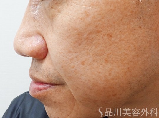 症例NO.70889のAFTER写真