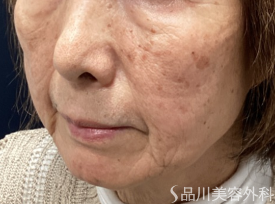 症例NO.73425のBEFORE写真