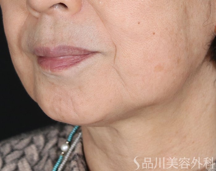 症例NO.72290のBEFORE写真