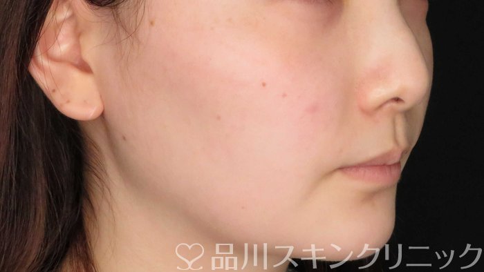 症例NO.71092のBEFORE写真