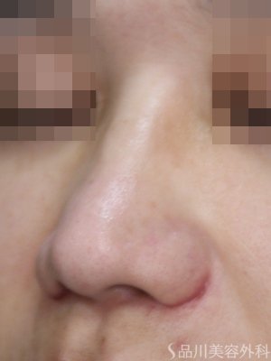 症例NO.75045のAFTER写真