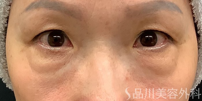症例NO.71228のBEFORE写真