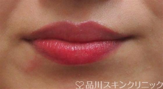 症例NO.31539のBEFORE写真