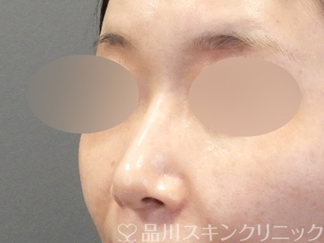 症例NO.68927のBEFORE写真