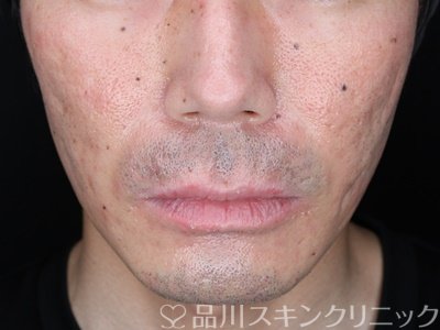 症例NO.70701のAFTER写真