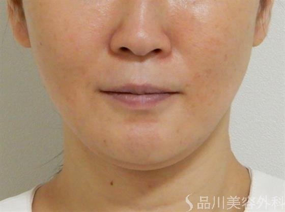 症例NO.37674のAFTER写真