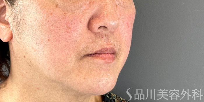 症例NO.72413のBEFORE写真