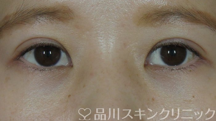 症例NO.71771のAFTER写真