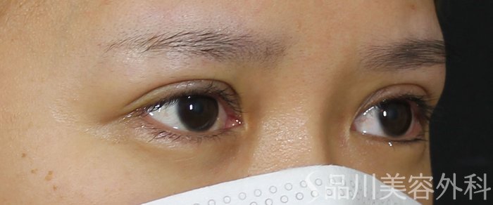 症例NO.69535のAFTER写真