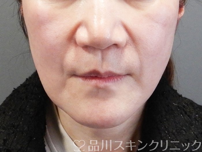 症例NO.73576のBEFORE写真