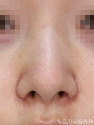 症例NO.72620のAFTER写真