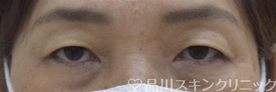 症例NO.53597のBEFORE写真