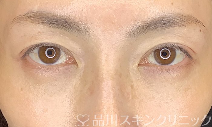 症例NO.70374のAFTER写真