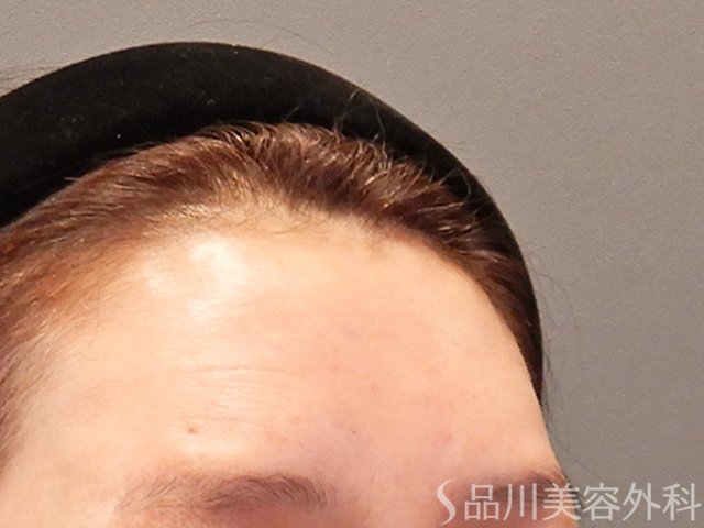 症例NO.73970のAFTER写真