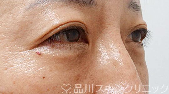症例NO.66606のAFTER写真