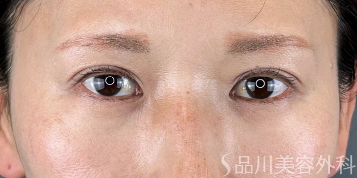 症例NO.70306のAFTER写真