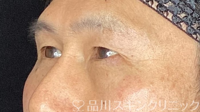 症例NO.71419のBEFORE写真