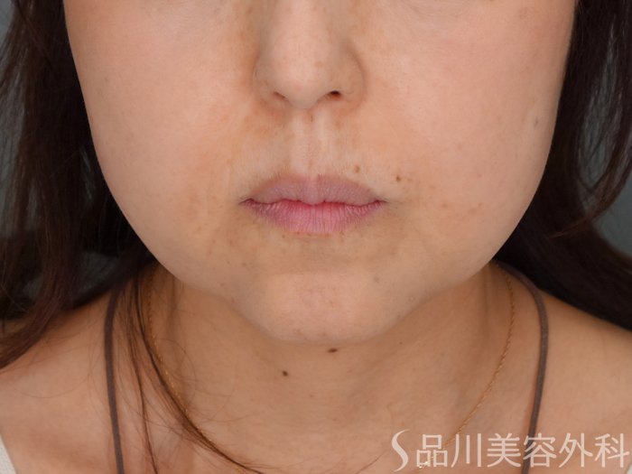 症例NO.70554のBEFORE写真