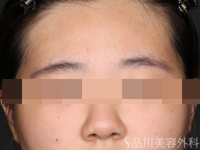 症例NO.75116のAFTER写真