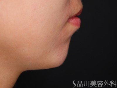 症例NO.65039のAFTER写真