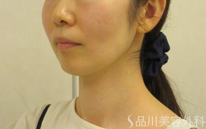 症例NO.71957のAFTER写真