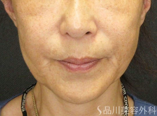 症例NO.66866のBEFORE写真