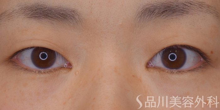 症例NO.72320のBEFORE写真