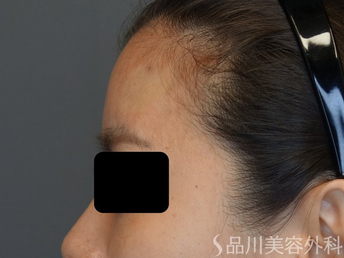 症例NO.74041のAFTER写真