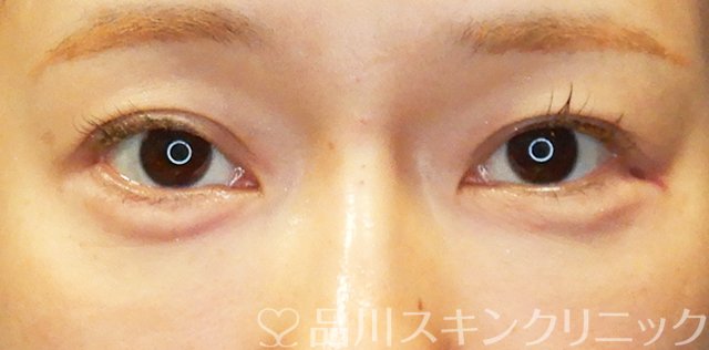 症例NO.67709のAFTER写真