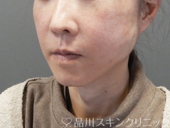 症例NO.73024のAFTER写真