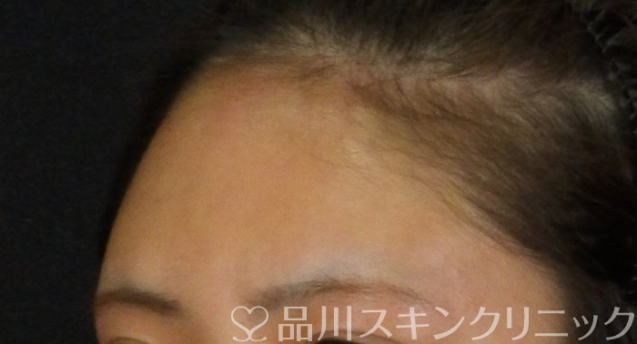 症例NO.72795のAFTER写真