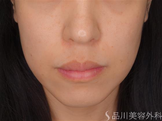症例NO.54349のBEFORE写真
