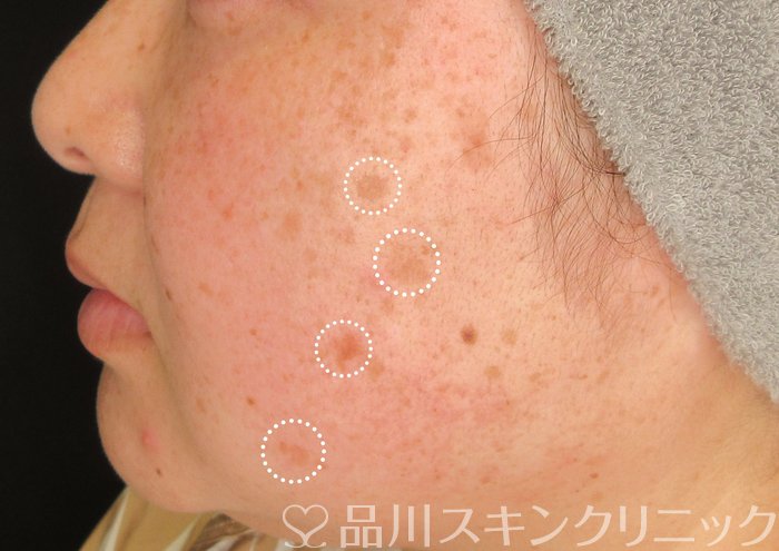 症例NO.73929のBEFORE写真