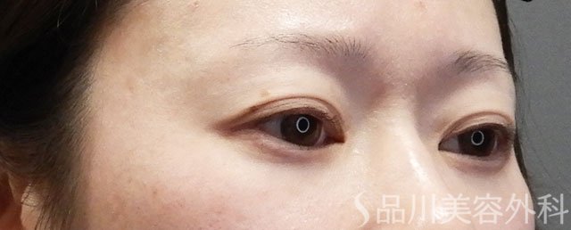 症例NO.73107のBEFORE写真