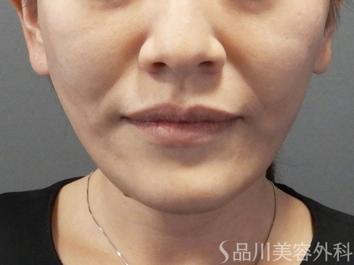 症例NO.73145のAFTER写真