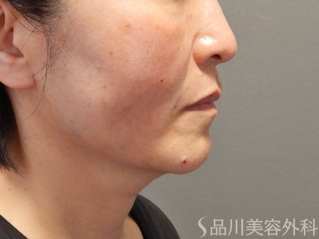 症例NO.74390のAFTER写真