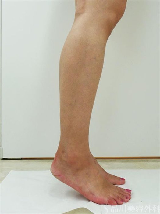 症例NO.44170のAFTER写真