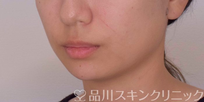 症例NO.67764のAFTER写真