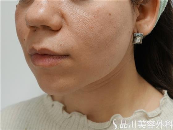 症例NO.41751のAFTER写真