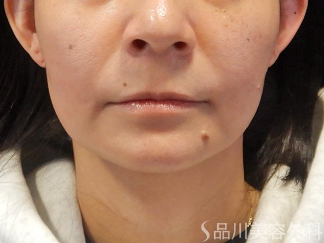 症例NO.73685のBEFORE写真