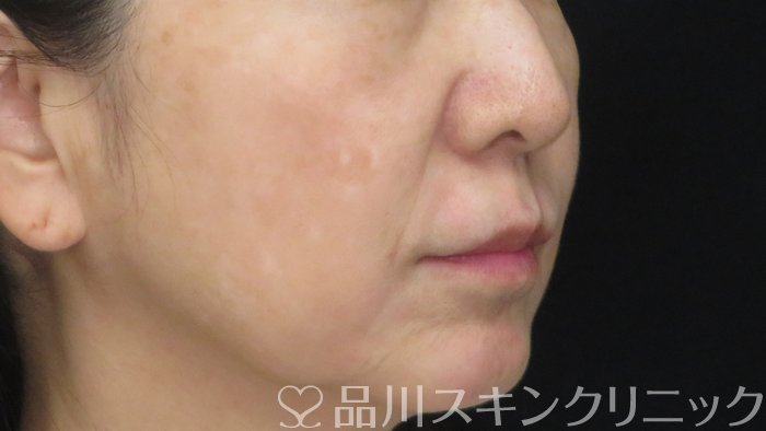 症例NO.72014のAFTER写真