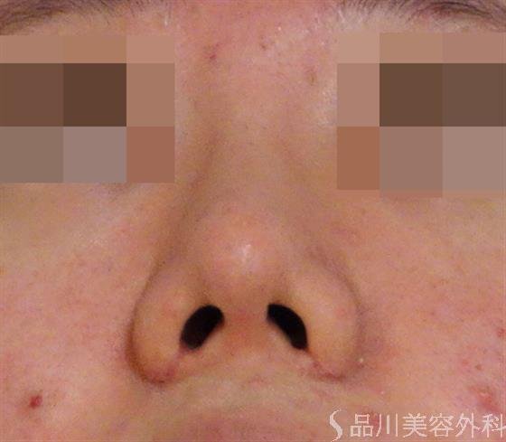 症例NO.40038のAFTER写真