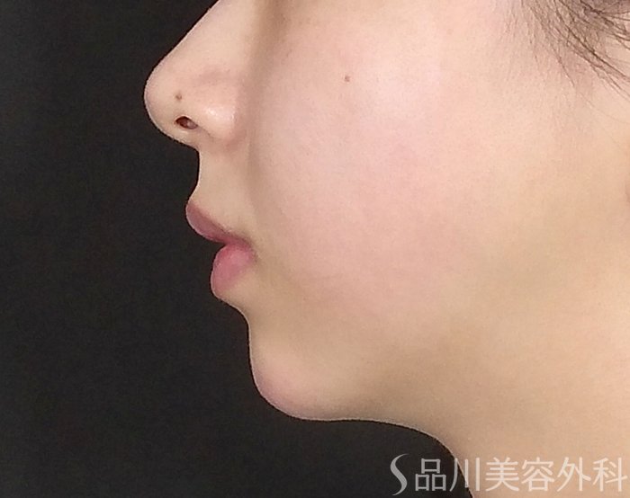 症例NO.71688のAFTER写真