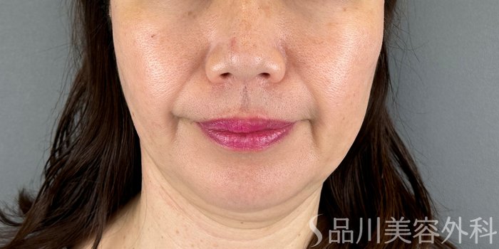 症例NO.67950のAFTER写真
