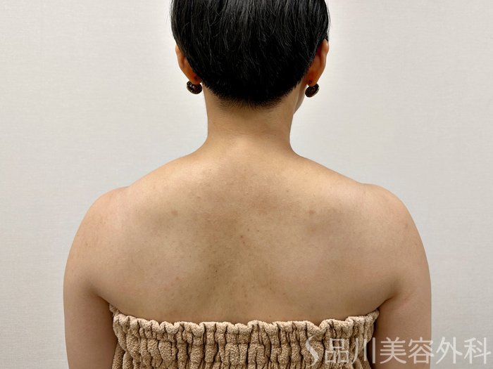 症例NO.73713のBEFORE写真