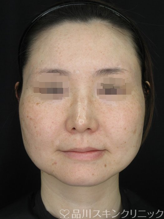 症例NO.71649のBEFORE写真