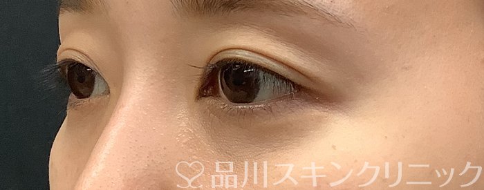 症例NO.69447のAFTER写真