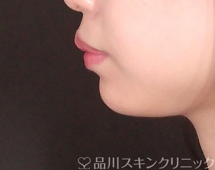 症例NO.69977のAFTER写真
